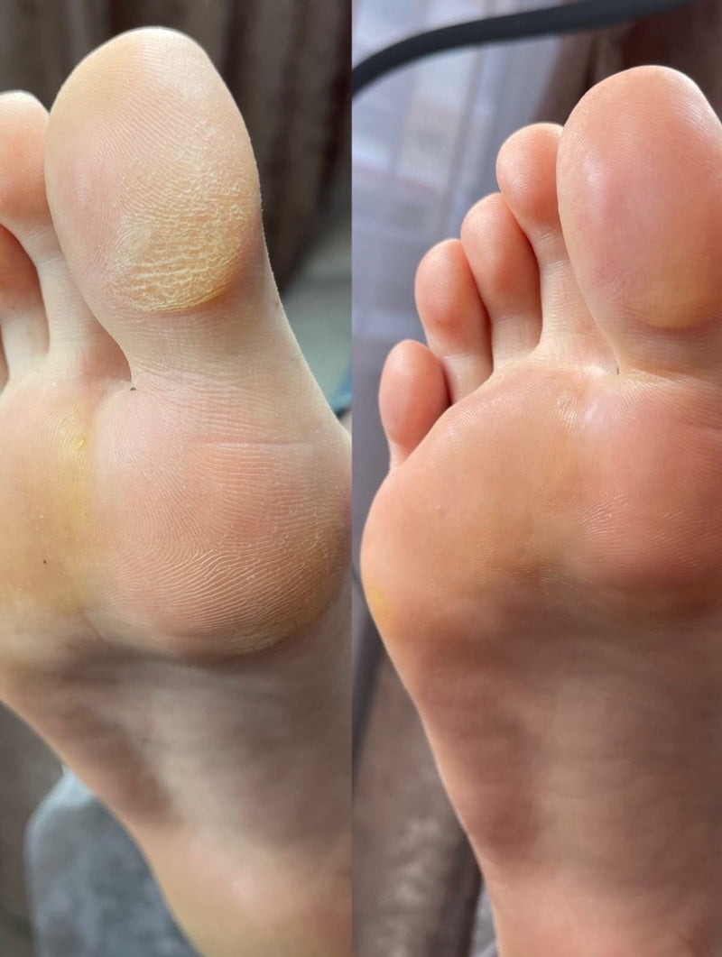 Pedikyr (behandling av fotsålen)